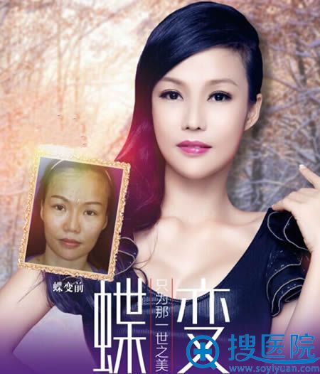 福州新世纪整形案例对比图