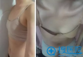【亲身经历】刚在上海首尔丽格找麻生泰院长做完隆胸恢复过程图