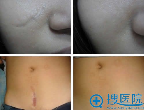 深圳广和整形疤痕修复案例图