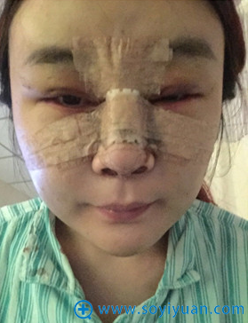 在上海华美做隆鼻+双眼皮+面部脂肪填充术后照