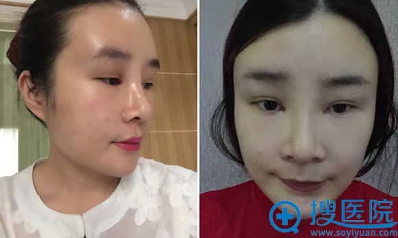 在上海华美做隆鼻+双眼皮+面部脂肪填充术后10天