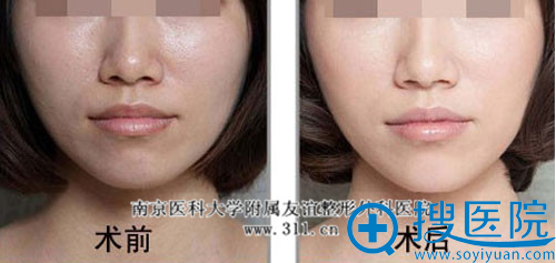 南整外美白微针美肤嫩肤案例 南整外美白微针美肤嫩肤案例