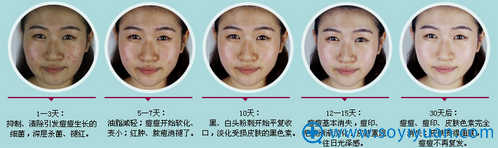 南整外祛青春痘恢复过程图 南整外祛青春痘恢复过程图