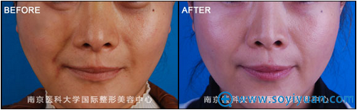 南整外祛皱案例 南整外祛皱案例