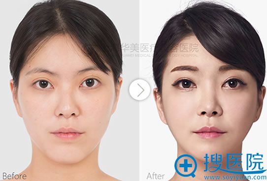 上海华美鼻部综合整形+V-Line成形术对比案例