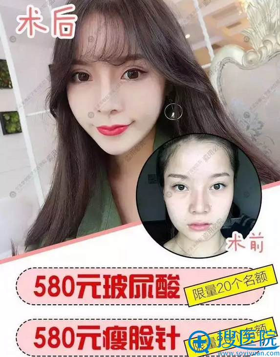 华美紫馨、玻尿酸价格580元