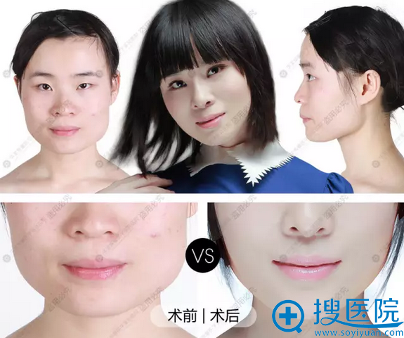 华美紫+玻尿酸丰下巴改脸型前后对比照