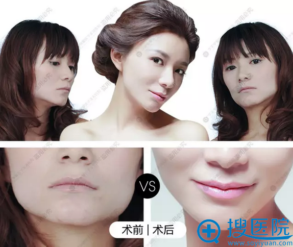 华美紫馨+玻尿酸丰太阳穴瘦脸案例