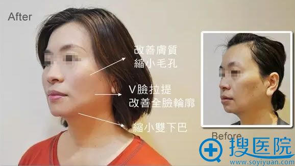 面部线雕提升术真人案例