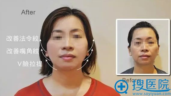 面部线雕提升术真人案例
