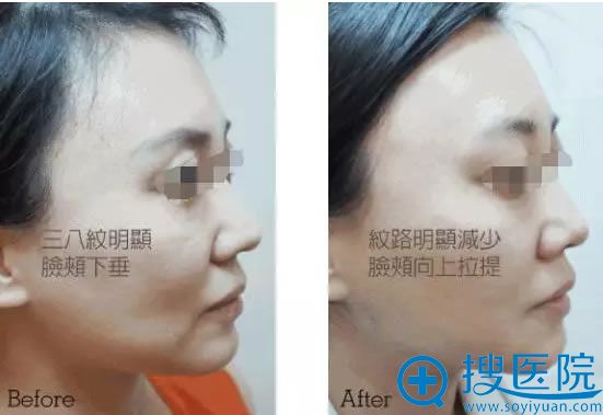 面部线雕提升术前后对比案例