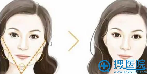 方形脸方案：瘦脸针+玻尿酸丰下巴效果对比