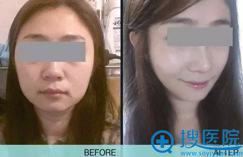 上海华美注射玻尿酸瘦脸针案例对比