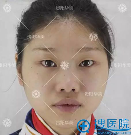 在贵阳华美做双眼皮术前照