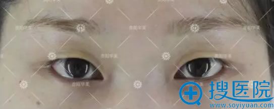 肿泡眼让眼睛暗淡无神
