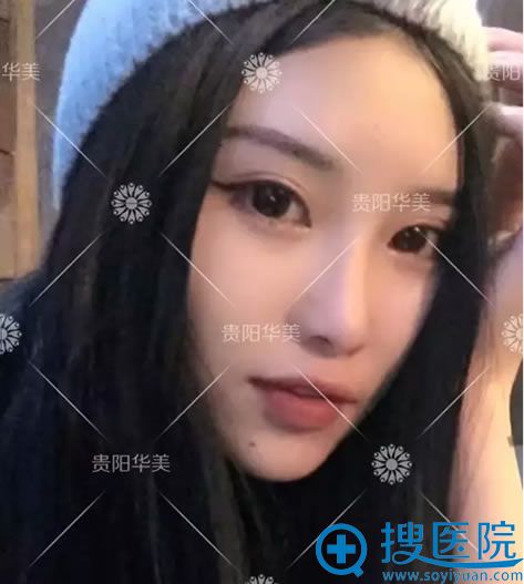 在贵阳华美做双眼皮术后照