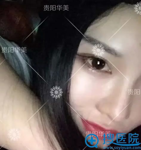 在贵阳华美单眼皮变双眼皮的效果