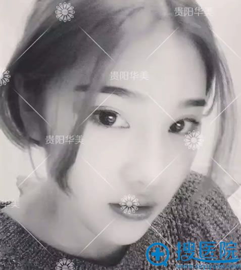 贵阳整形医院做双眼皮术后效果