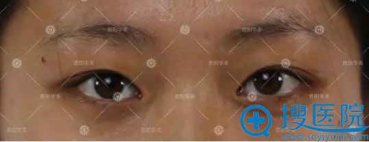 过窄的双眼皮术前照