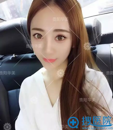 单眼皮丑女大翻身效果用图说话