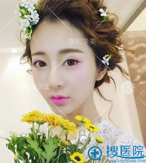 在贵阳华美做双眼皮的效果