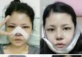 我在韩国巴诺巴奇找吴昌铉院长做面部轮廓+眼鼻整形恢复过程