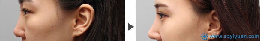 上海美莱假体隆鼻术后效果