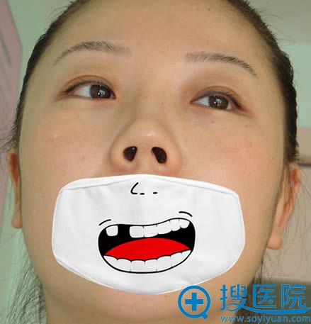 在北京丽星找魏志香院长做双眼皮+假体隆鼻修复术前照