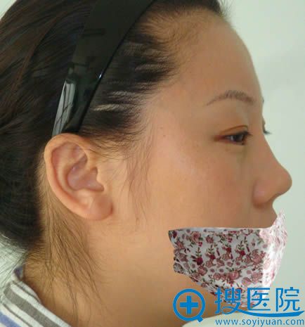 在北京丽星做双眼皮+假体隆鼻修复术前侧面照