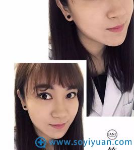 术后4个月恢复情况