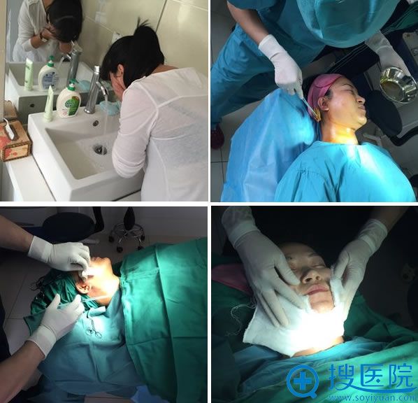 面部吸脂手术全过程