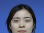北京圣嘉新张笑天做长曲线下颌角截骨整形案例 3个月摆脱国字脸