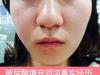 上海百达丽整形医院王维注射玻尿酸填充泪沟案例 瑞蓝3800元