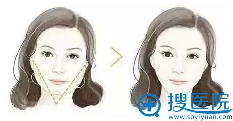面部吸脂瘦脸可以打造精致V脸
