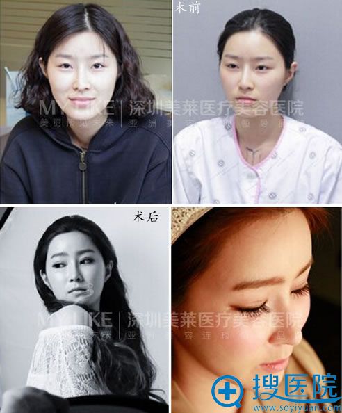深圳美莱整形美容医院双眼皮案例
