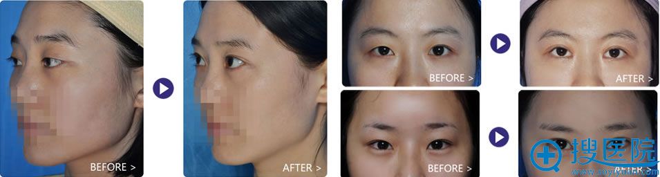 深圳米兰柏羽医学美容医院双眼皮案例