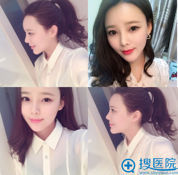 隆鼻术后20天恢复期图片