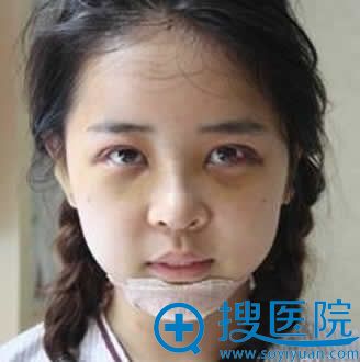 做眼睛鼻子手术第四天照片
