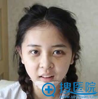 双眼皮和隆鼻手术恢复过程图