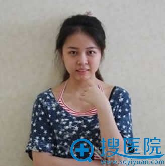 做完软骨隆鼻手术第10天照片