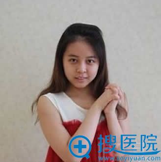 北京华韩双眼皮和隆鼻手术效果图