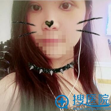 术后7天拆线了