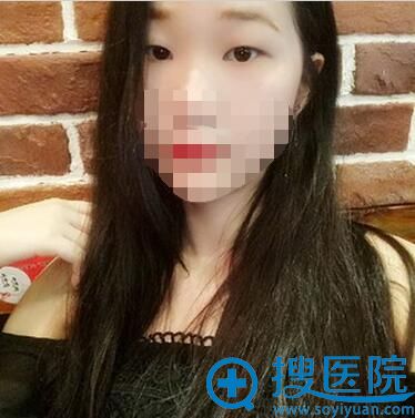 双眼皮+开眼角术前照片