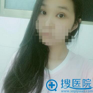 术后15天，眼睛还是有点肿