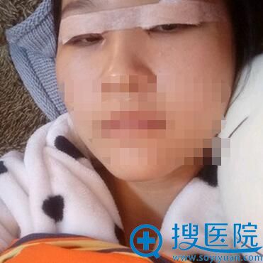 双眼皮+开眼角术后即刻