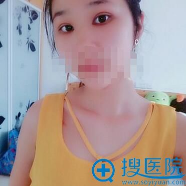 双眼皮+开眼角术后1个月恢复照片