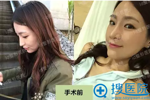 韩国id整容医院隆鼻失败修复案例30岁上班族的鼻整形真实后记 朴相薰id医院假体隆鼻 搜医院 韩国id整容医院隆鼻失败修复案例30岁上班族的鼻整形真实后记 朴相薰id医院假体隆鼻 搜医院