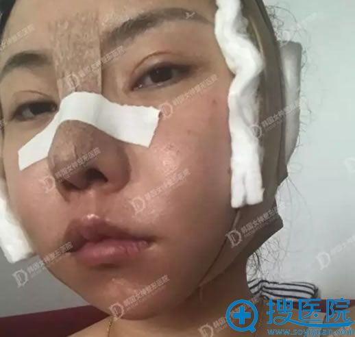 在韩国女神整形外科做面部轮廓术后第2天