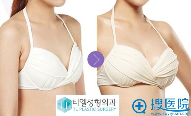 韩国TL胸部整形案例效果图