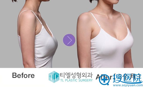 韩国TL胸部下垂矫正案例图
